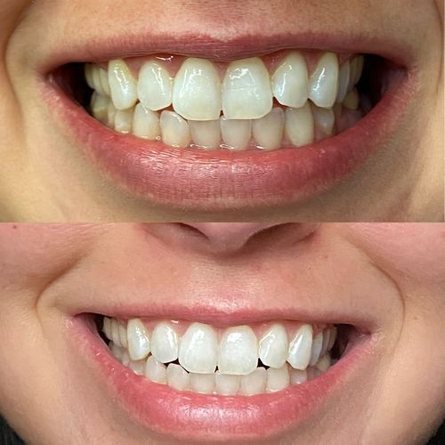 Bandes de blanchiment dentaire PAP+ Charbon