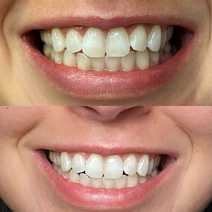 Bandes de blanchiment dentaire PAP+ Charbon